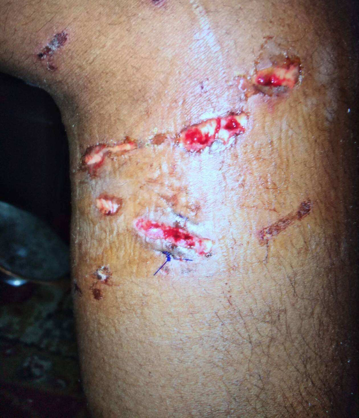 Charles Carey leg wound